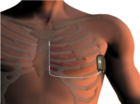 difference entre pacemaker et defibrillateur